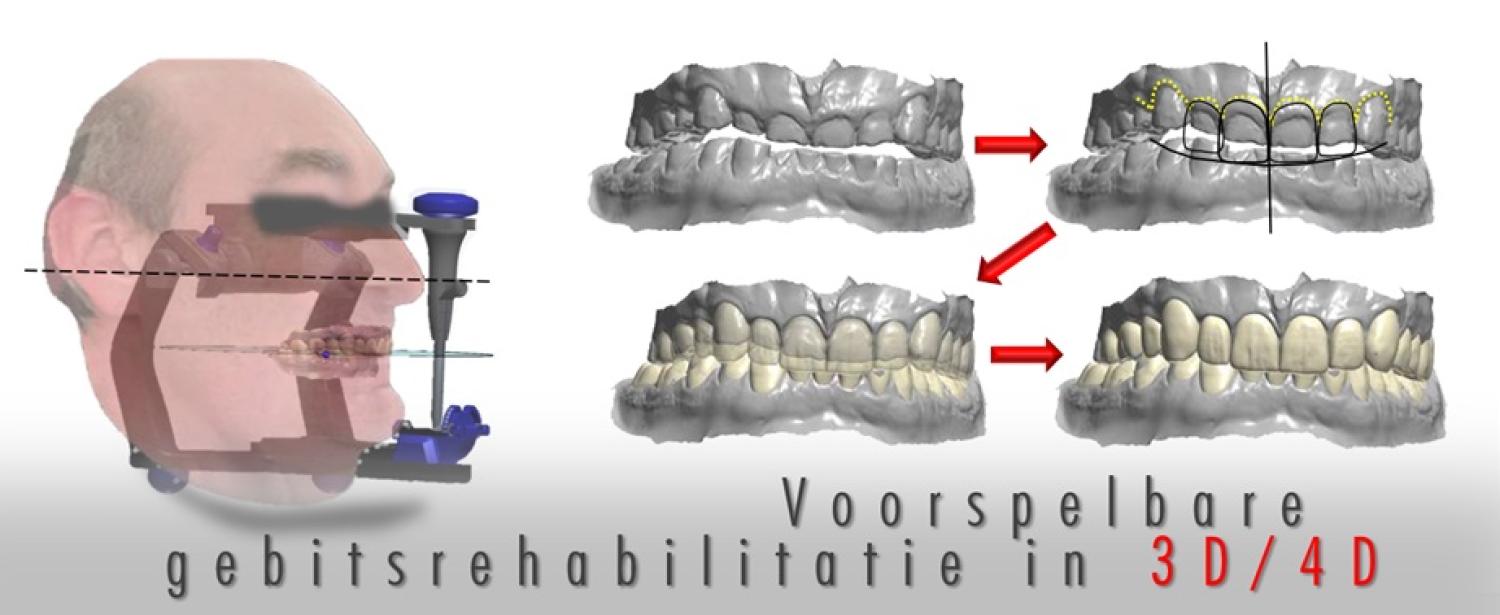 Plannen van (complexe) gebitsrehabilitatie in 5 stappen